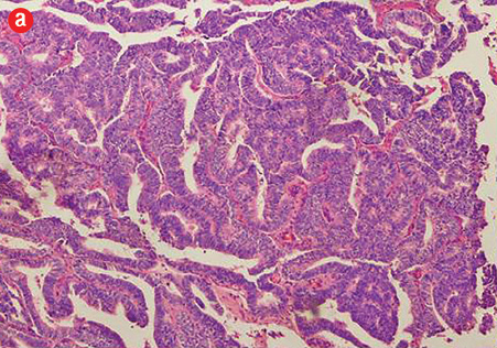 acinar carcinoma of the prostate