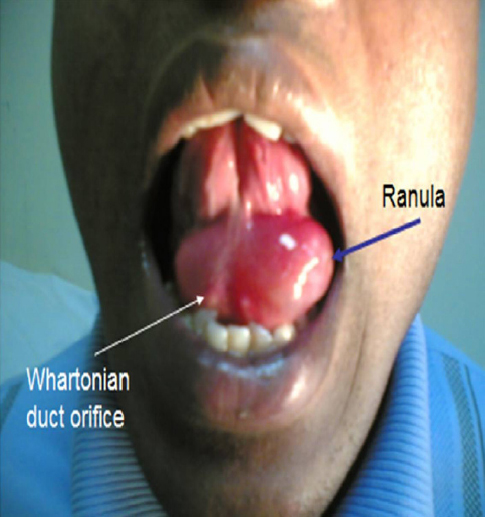 Mucocele (syn. mucous extravasation cyst; mucous retention ...