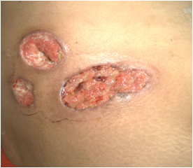 Figure 1 Pyoderma