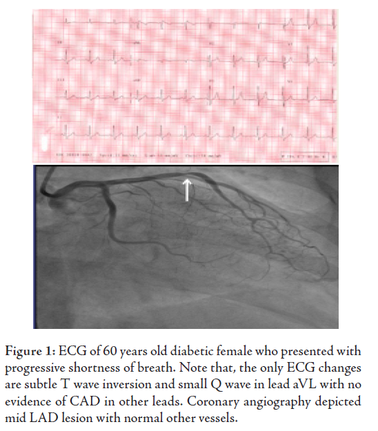 Ischemia On Ecg. Other ECG ischemic changes in