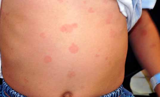 Visual guide to children's rashes and skin conditions ...