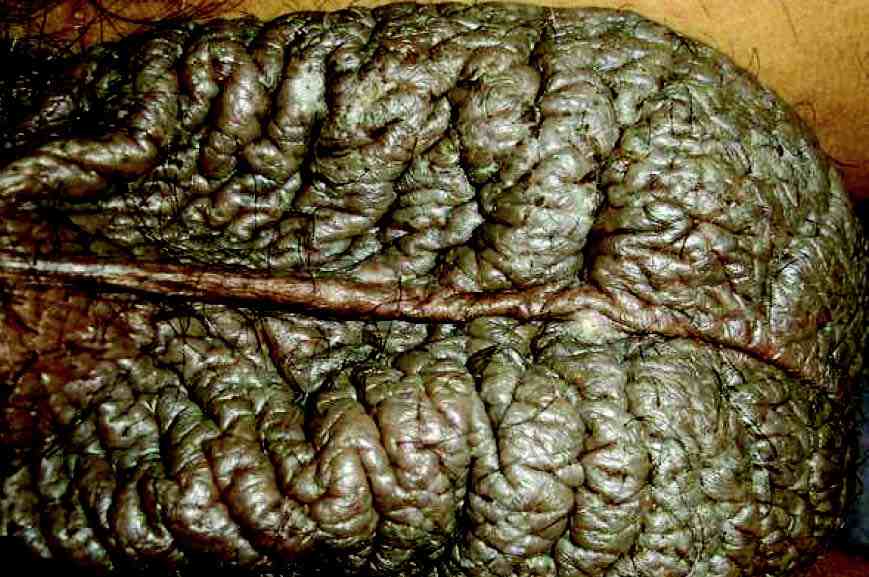 Scrotal Psoriasis Images - scalp psoriasis around hairline