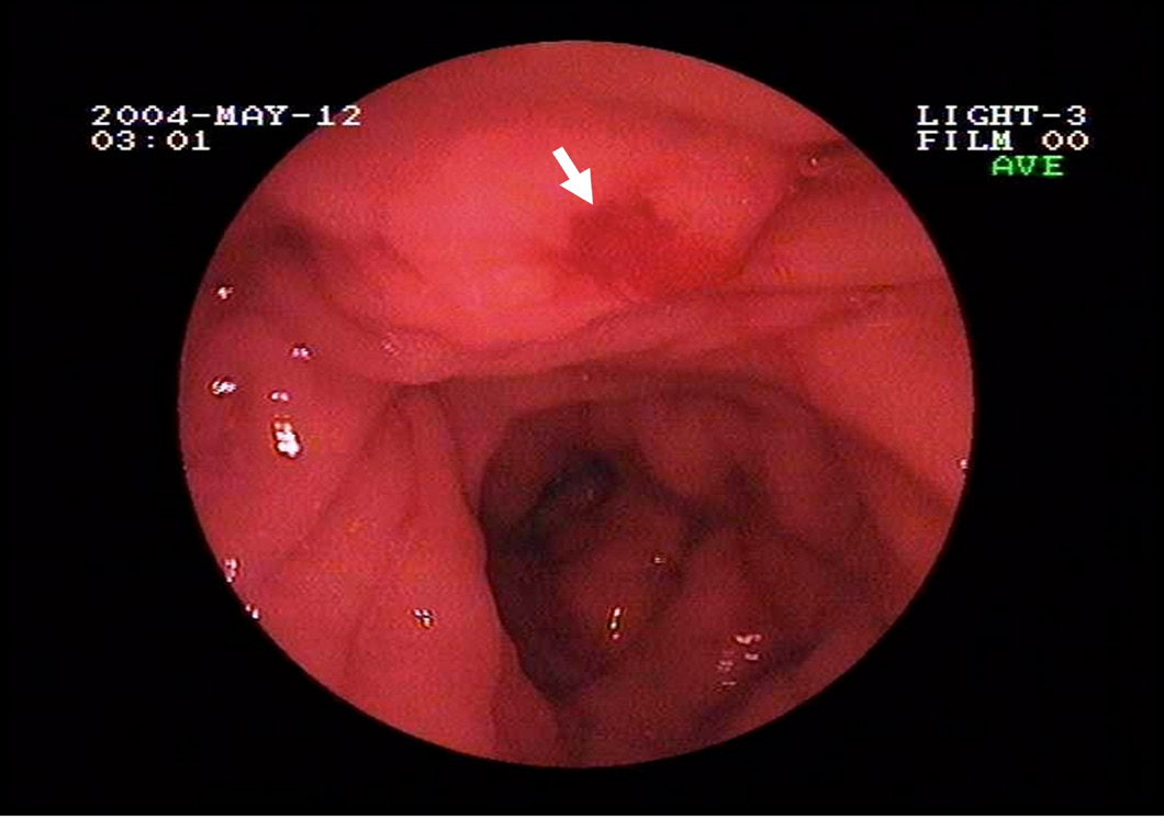 ... pregnancy precipitates this condition in women with underlying chronic ... ... pregnancy precipitates this condition in women with underlying chronic ...