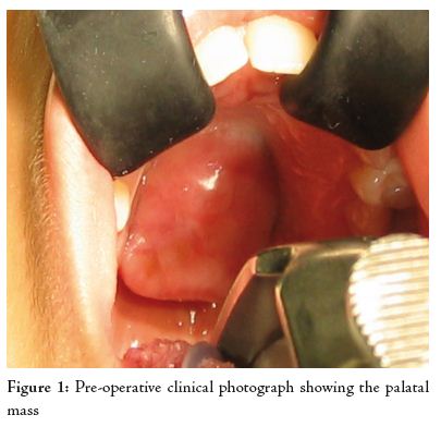 Palate Mass