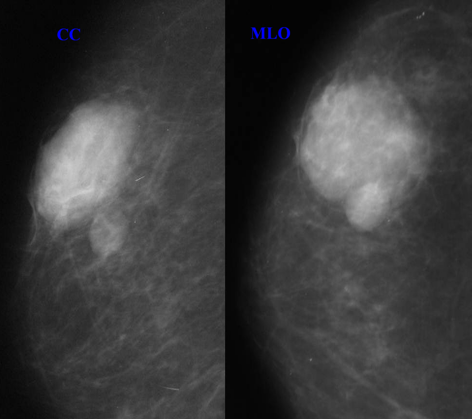 Mammogram atypical mass large breasts Oman Medical Journal Archive